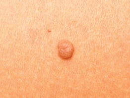 Skin Mole