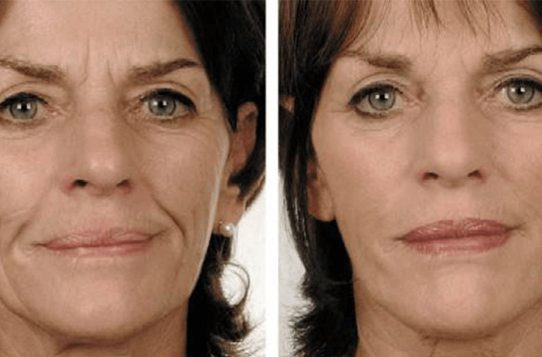 Dermal Fillers Before and After