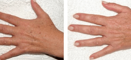 Pigmentation Hand