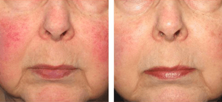 Skin Redness and Flushing