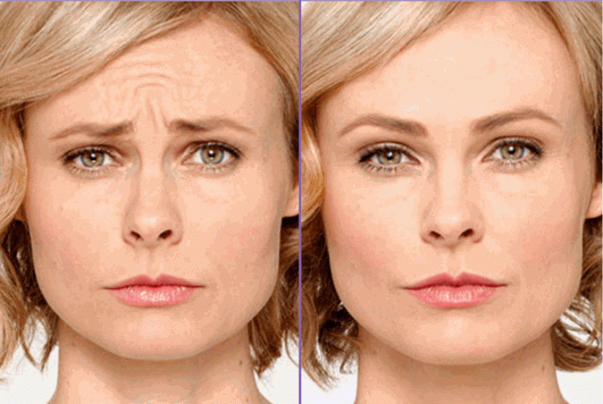 Botox® on Face Before and After