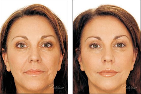 Liquid Face Lift With Dermal Filler