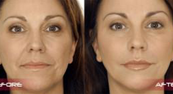 Dermal Fillers Before and After