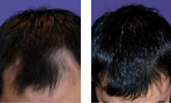 Hair Loss Before and After