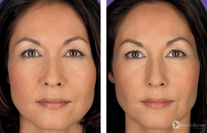 Liquid Face Lift With Dermal Filler