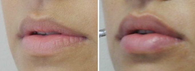 Lip Echancement Before and After