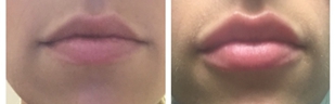 Lip Echancement Before and After