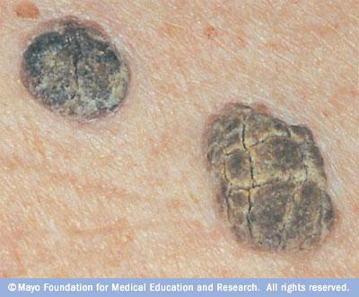 Seborrhoeic Keratoses