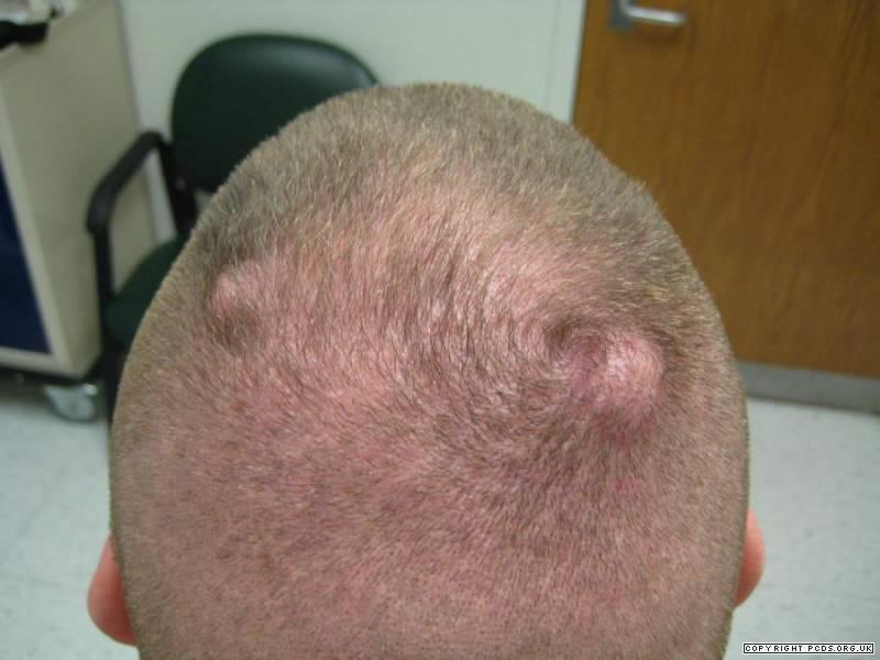 Sebaceous Cyst / Pilar Cyst / Epidermoid Cyst