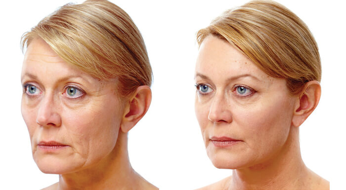 Liquid Face Lift With Dermal Filler