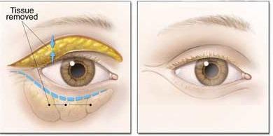 Blepharoplasty Diagram