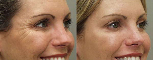 Botox® on Face Before and After