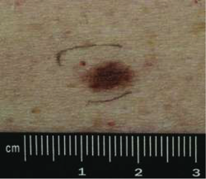 Dysplastic Nevus