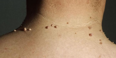 Skin Tags on Neck