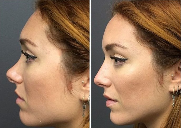 Non-surgical Nose Job Before and After