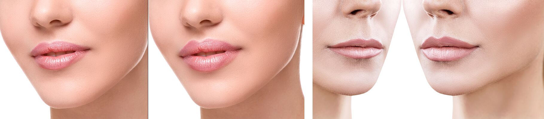 lip fillers before and after