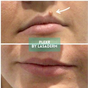 Lasaderm plexr mole removal