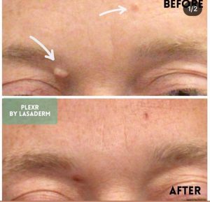 brow mole removal plexr