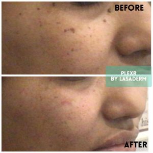 cheek mole plexr treatment