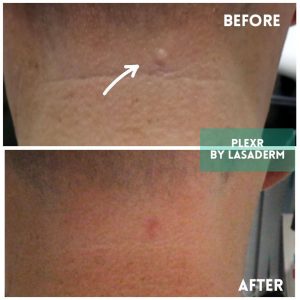 plexr neck mole removal