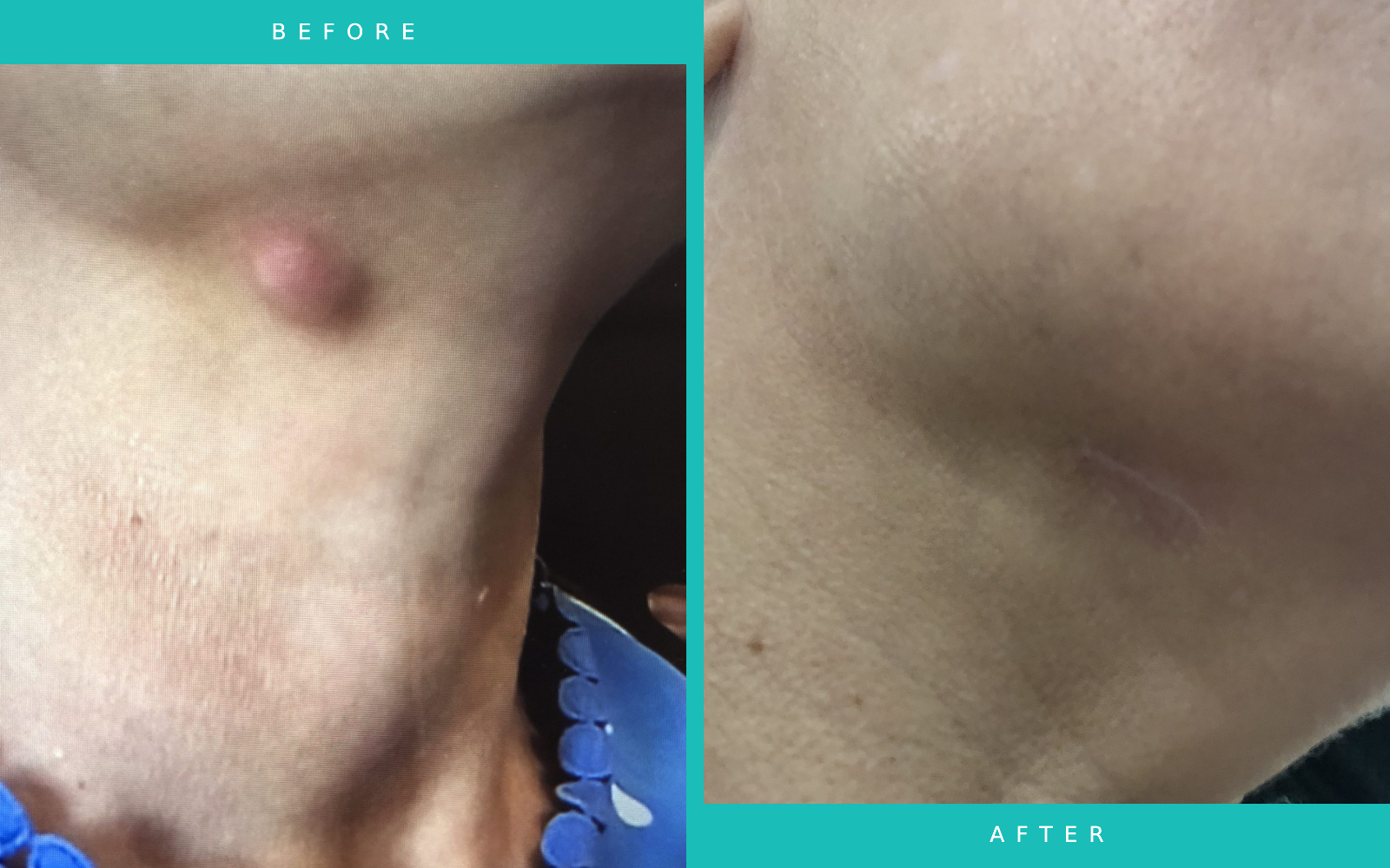 Before and After Cyst Removal Louise