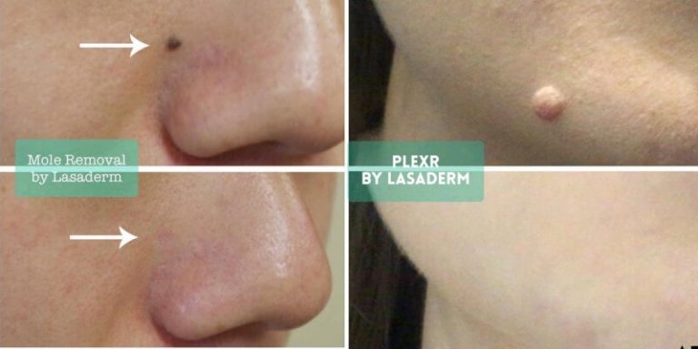 PlexR Removal On Face