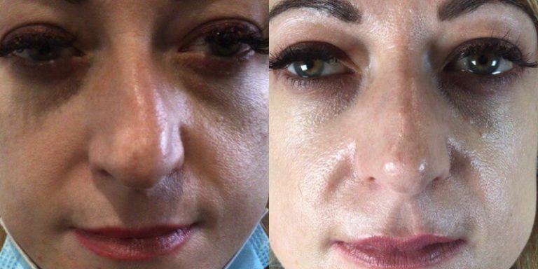 Nose Filler Before and After