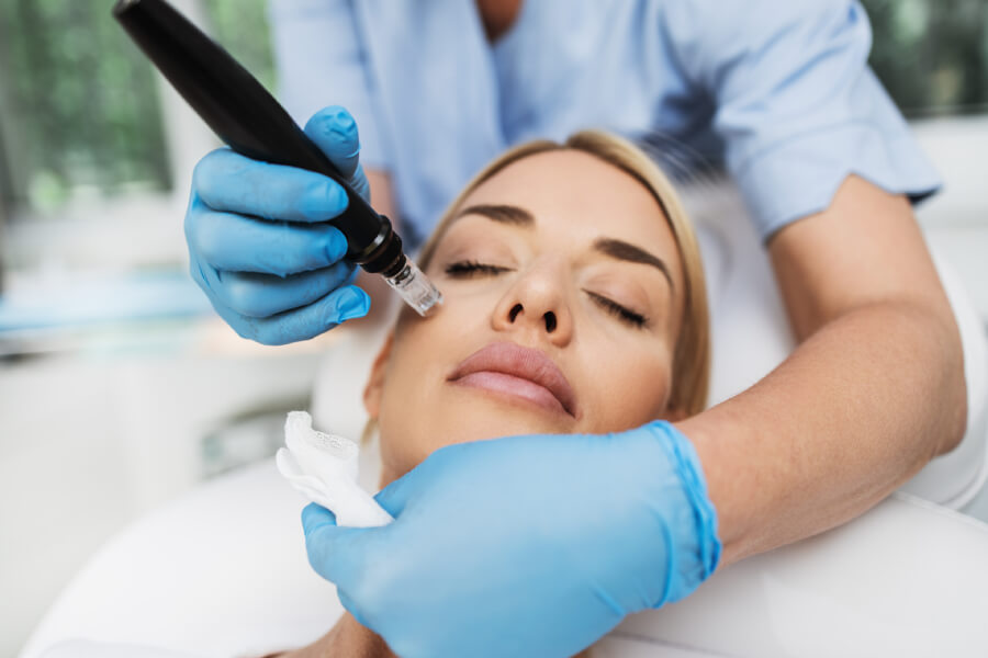 PRP Treatment Using Microneedling