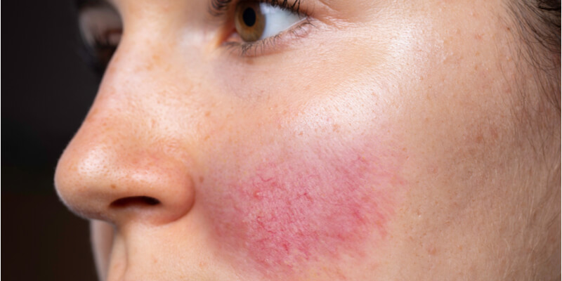 Rosacea On Cheek