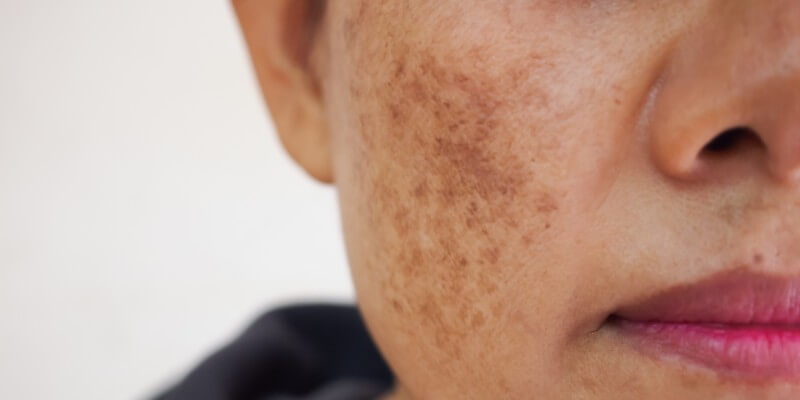 Hyperpigmentation On The Cheek