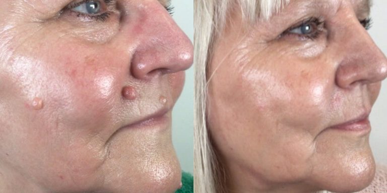 PlexR Face Mole Removal