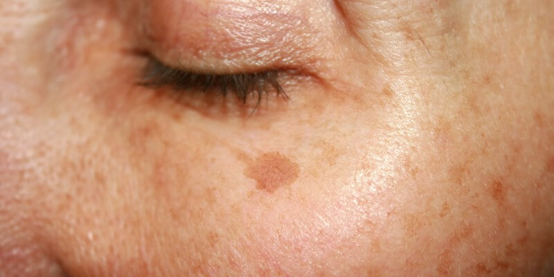 Pigmentation Under The Eye