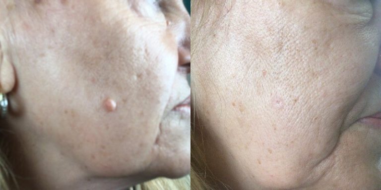 PlexR Mole Removal Treatment