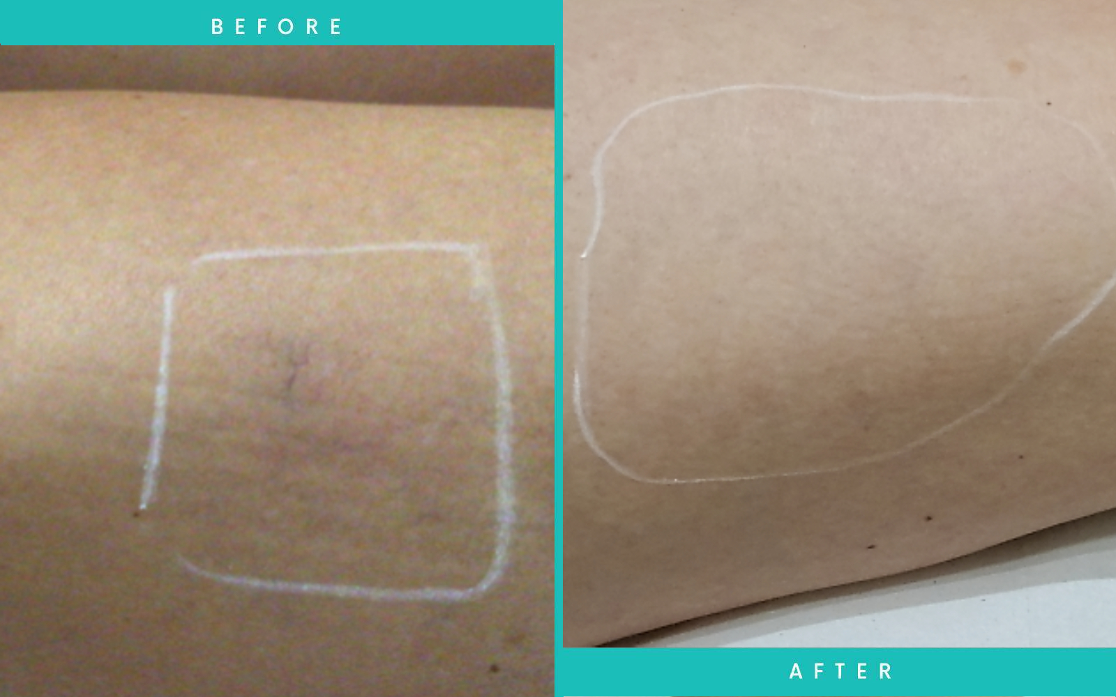 Thread Vein Removal Before and After