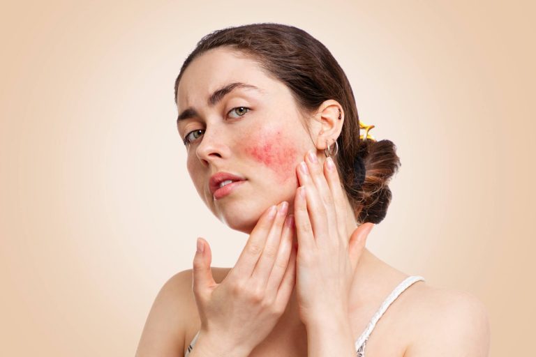 rosacea on girls skin