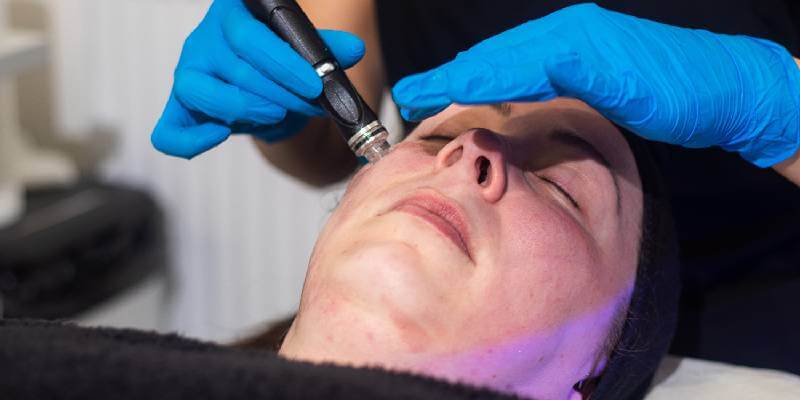 Hydrafacial For Hyperpigmentation