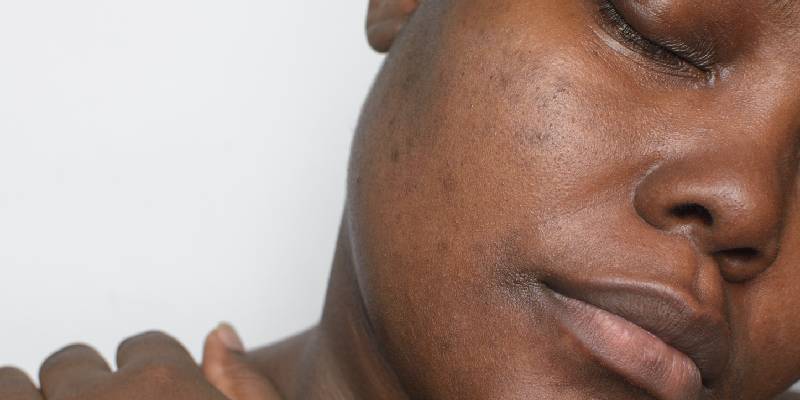 Hyperpigmentation Dark Spots