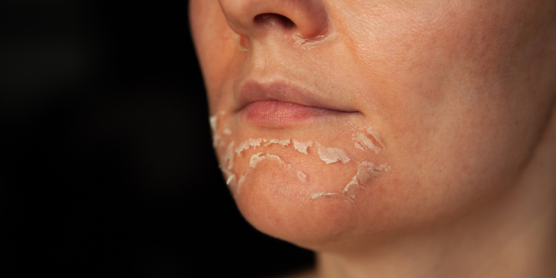 Skin peeling